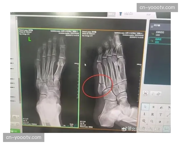 何宇鹏跖骨骨折康复周期较长 右路防守深度需要补充